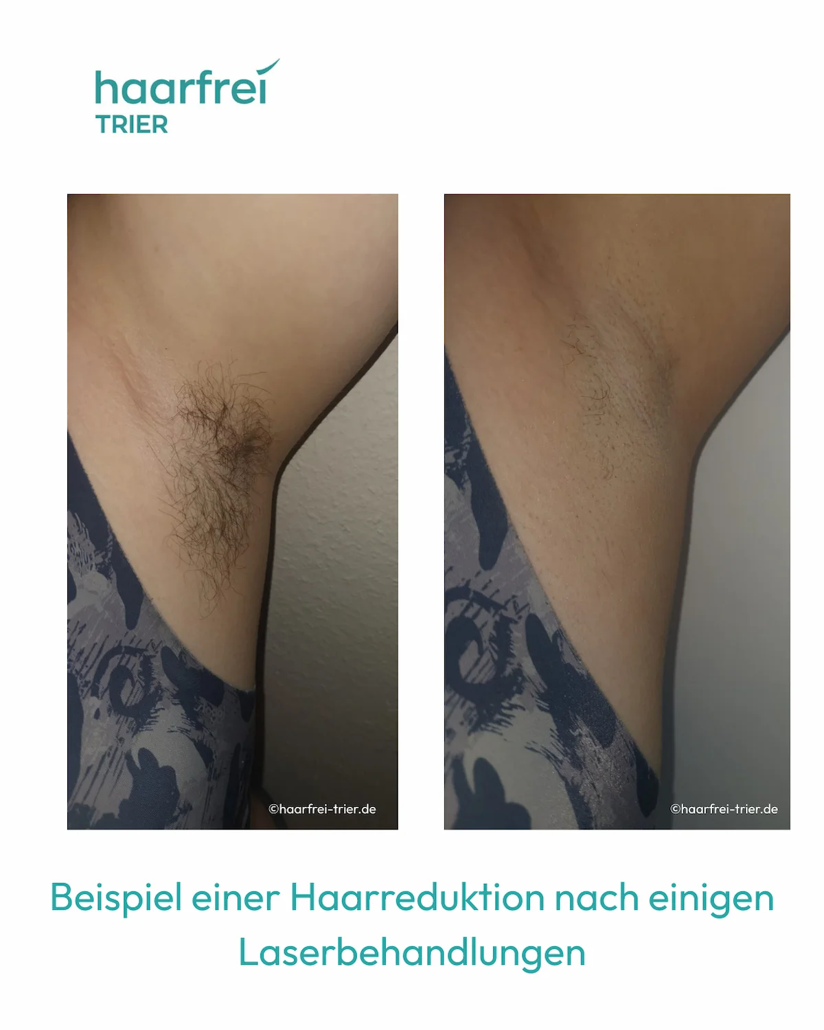 Laser Haarentfernung Achseln Trier – Vorher Nachher