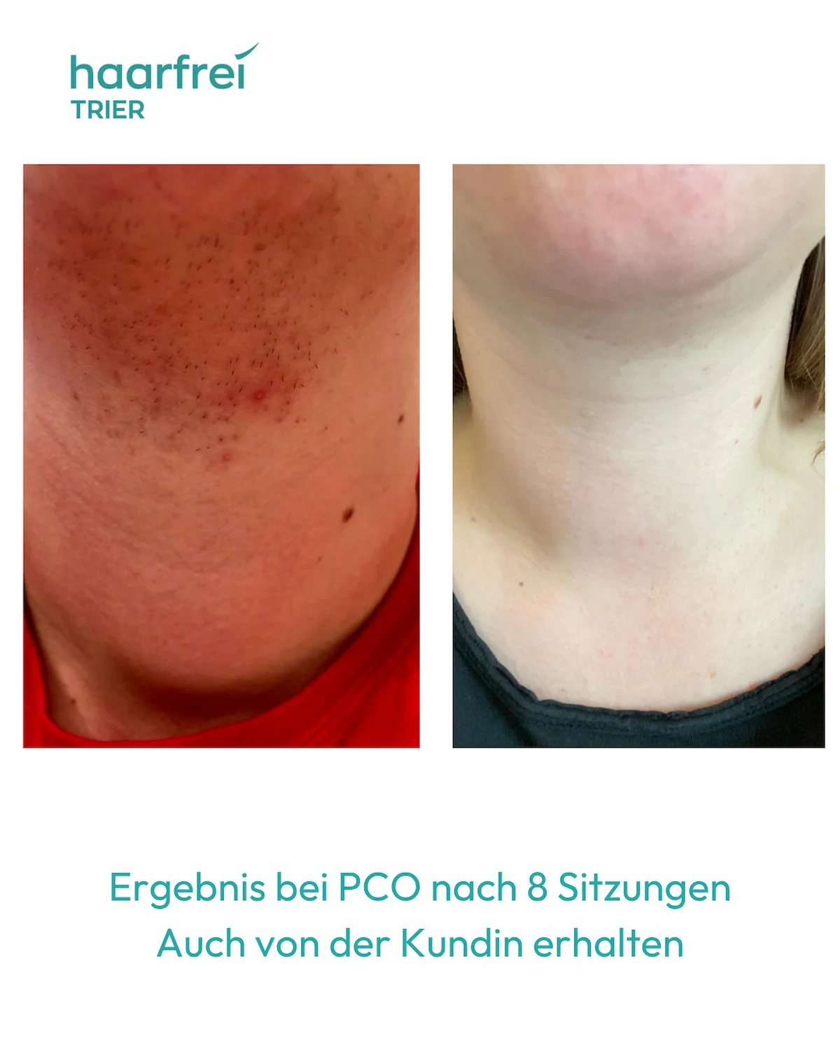 Haarentfernung Hals PCO-Behaarung Trier – nach 8 Sitzungen
