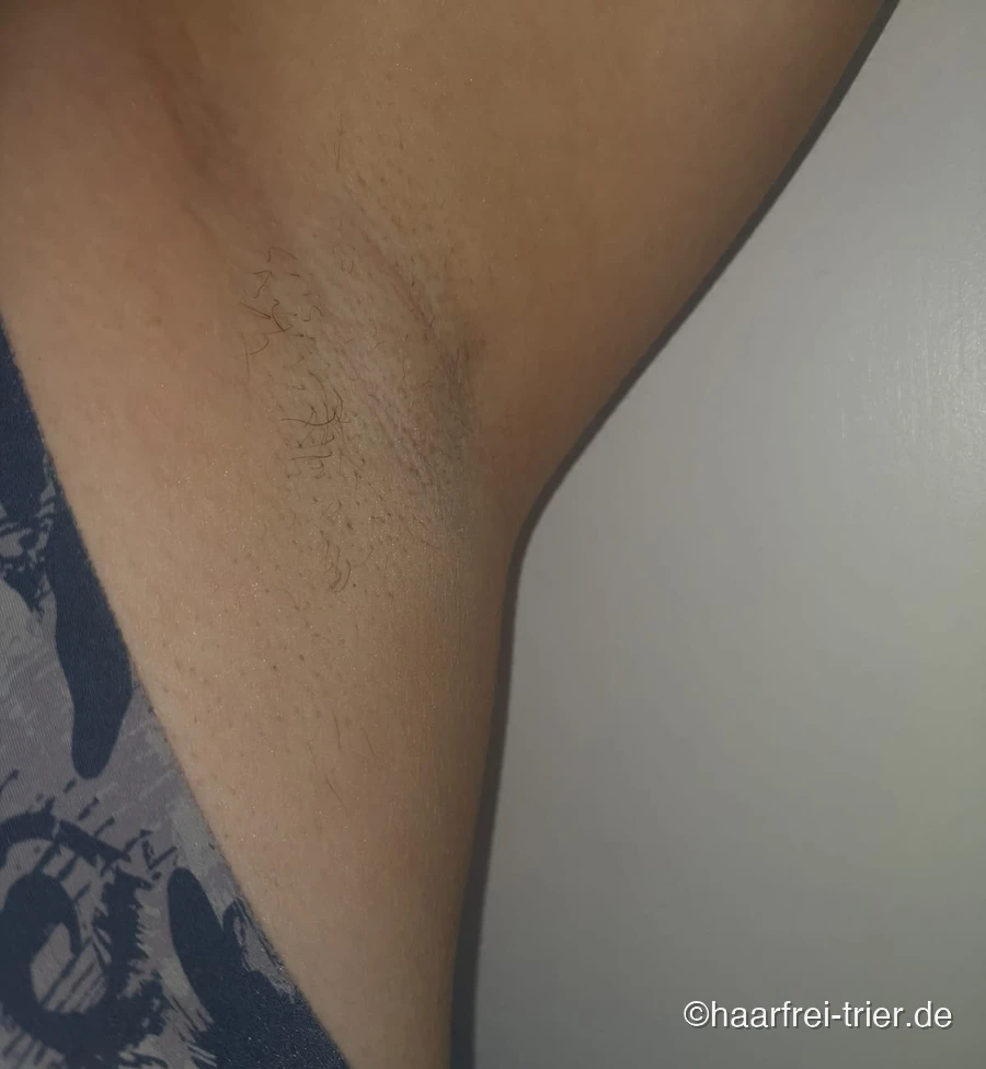 Laser Haarentfernung Achseln Trier – nachher